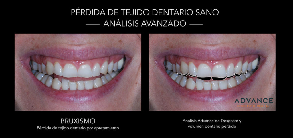 No usar una férula nocturna multiplica el desgaste dental - Clinica Dental  Advance