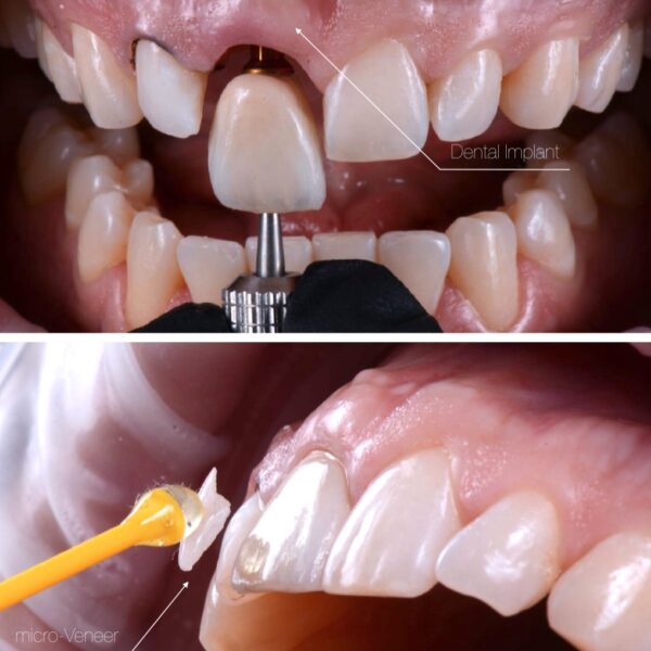 Afectar creer precoz Prótesis dental - Clinica Dental Advance