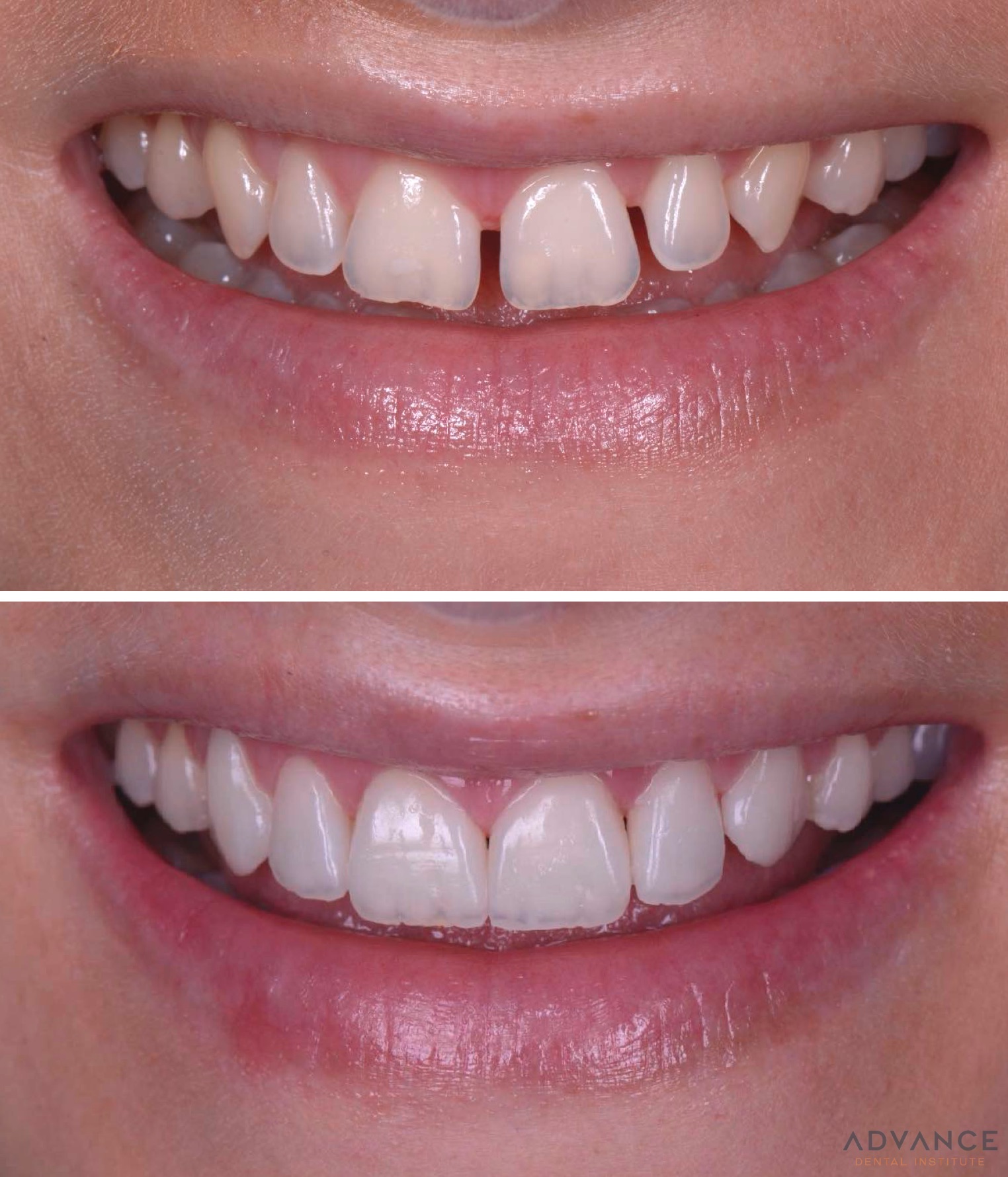 Dientes Postizos Temporal Sonrisa Dental Carilla Estetica - VERALY