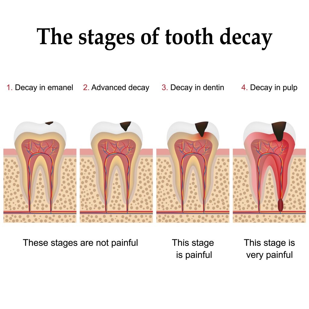 Endodonthics tooth decay restoration in Mallorca