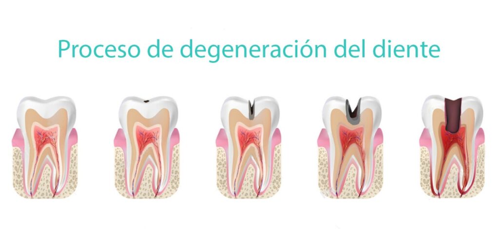 Endodoncia en mallorca para regeneración del diente por caries u otros factores