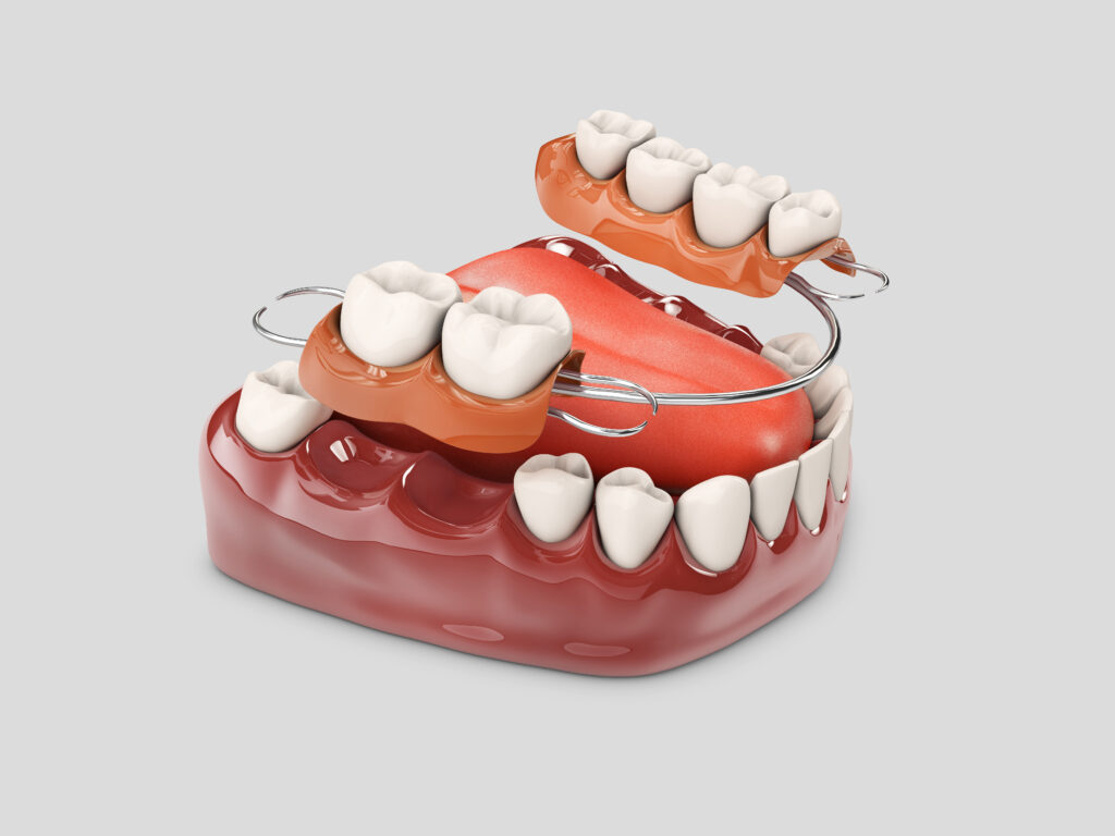 alternativas a los implantes dentales
