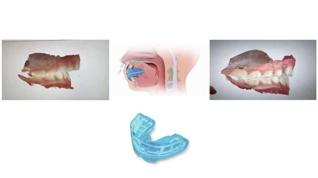 Respirador bucal y respirador nasal y como afecta a la oxigenación