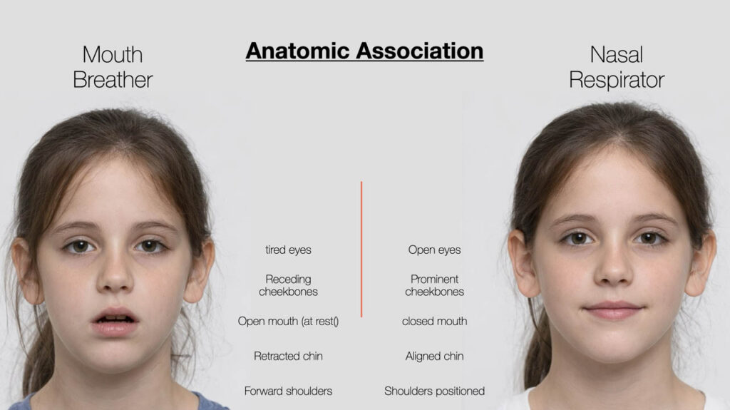 Facial profile of a mouth breather versus a nasal breather: chin, cheekbones and shoulders