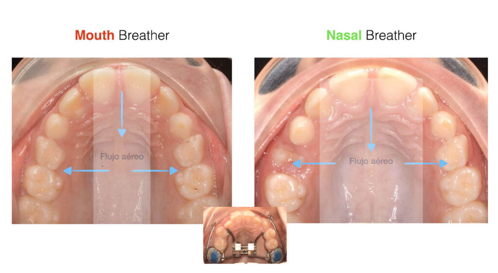 Mouth breather versus nasal breather