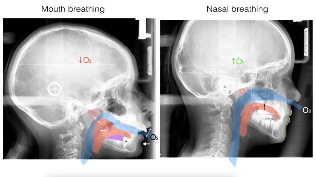 Mouth breathing and nasal breathing