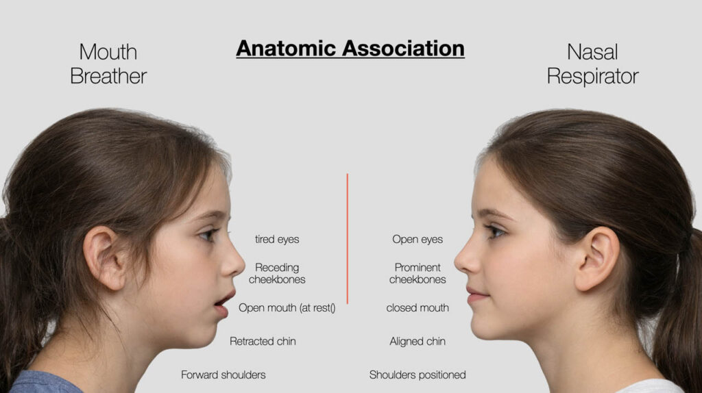 Facial profile of a mouth breather versus a nasal breather